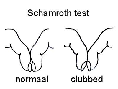 Schamroth test