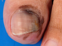 Acrolentigineus melanoom