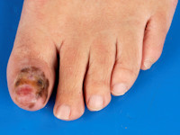 Acrolentigineus melanoom