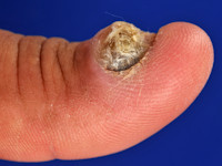 Acrolentigineus melanoom