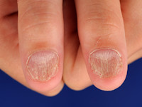 Trachyonychia, ruwe nagels