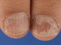 Trachyonychia, ruwe nagels