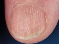 Trachyonychia, ruwe nagels