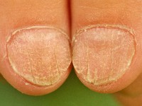 Twenty nail dystrophy of childhood