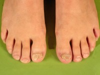 Twenty nail dystrophy of childhood