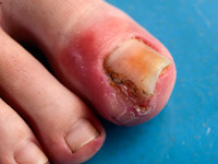 unguis incarnatus, ingrown toenail