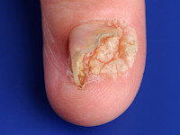 Wratten onder de nagel