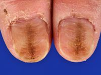 Washboard nails, habit - tick nails