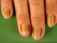 Yellow nail syndrome