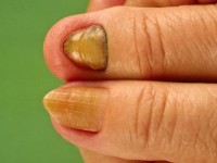 Yellow nail syndrome