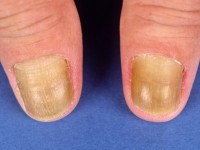 Yellow nail syndrome