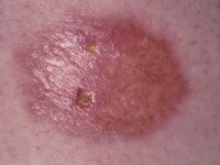 Necrobiosis lipoidica
