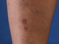 Necrobiosis lipoidica