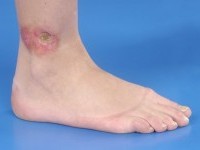 Necrobiosis lipoidica