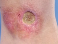 Necrobiosis lipoidica met ulceratie