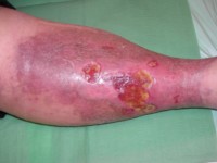 Necrobiosis lipoidica met ulceratie