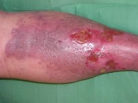 Necrobiosis lipoidica met ulceratie