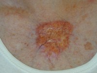 Necrobiotisch xanthogranuloom bij paraproteinemie