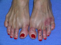 Necrolytic acral erythema