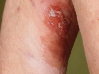 Necrolytisch migrerend erytheem