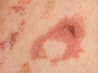 Necrolytisch migrerend erytheem