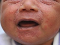 Neonatal cephalic pustulosis