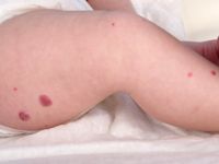 Diffuse neonatal hemangiomatosis