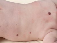 Diffuse neonatal hemangiomatosis