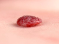 Diffuse neonatal hemangiomatosis