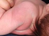 Subcutane neonatale vetnecrose