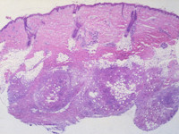 Subcutane neonatale vetnecrose