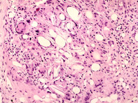 Subcutane neonatale vetnecrose