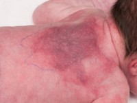 Subcutane neonatale vetnecrose