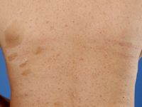 Neurofibromatosis type 1