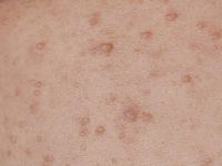 Neurofibromatosis type 1