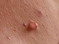 Neurofibromatosis type 1