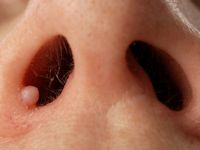 Neurofibromatosis type 1