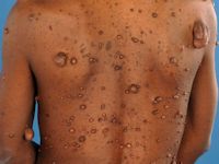 Neurofibromatosis type 1