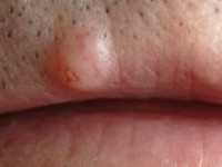 Neurofibroom op de bovenlip met branched vessels