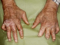 Wonden en amputaties