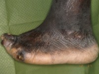 Neuropathische voet bij lepra