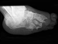 Neuropathische voet bij lepra