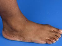 Neurothekeoma (nerve sheath myxoma)