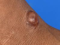 Neurothekeoma (nerve sheath myxoma)