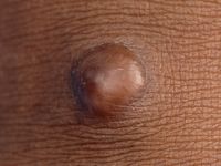 Neurothekeoma (nerve sheath myxoma)