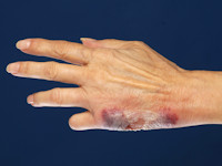 Neutrophilic dermatosis of the dorsal hands