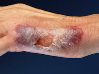 Neutrophilic dermatosis of the dorsal hands