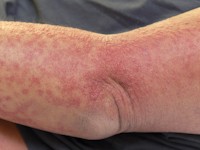 Neutrofiele eccriene hidradenitis