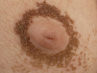 Nevoid hyperkeratosis of the areola