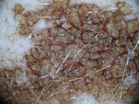 Nevoid hyperkeratosis of the areola